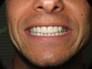 Dental-implants-After-Image