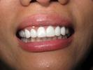 Dental-implants-After-Image