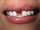 Dental-implants-Before-Image