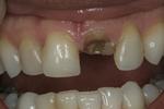 Dental-implants-Before-Image